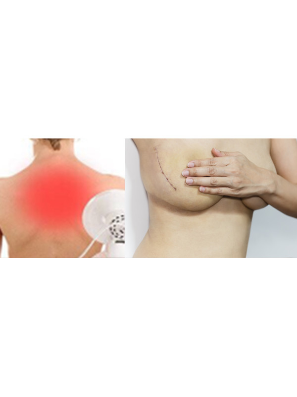 Płyn Po Radioterapii i Mastektomii Cerasept + Antybakteryjny 100ml