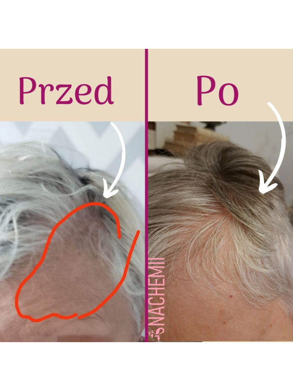 Serum stymulujące na porost włosów po chemioterapii Nachemii 100 ml