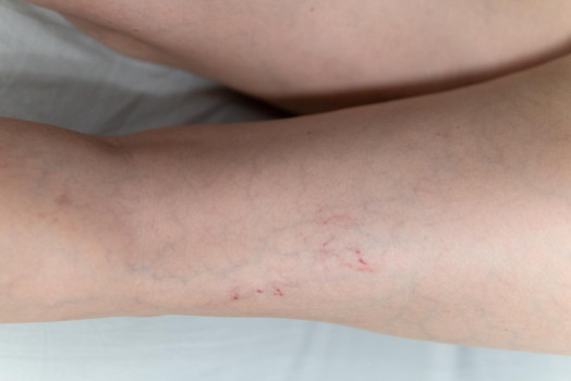 Jak wzmocnić naczynia krwionośne?